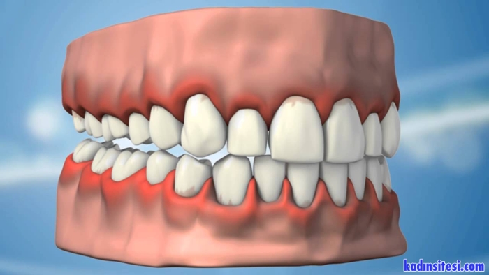diş etinin dişten ayrılması